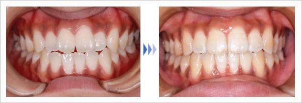 歯並びにお悩みの方への矯正歯科治療