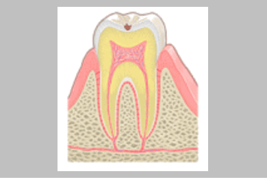 虫歯の初期段階で、歯の表面(エナメル質）だけが虫歯にかかっている状態です。